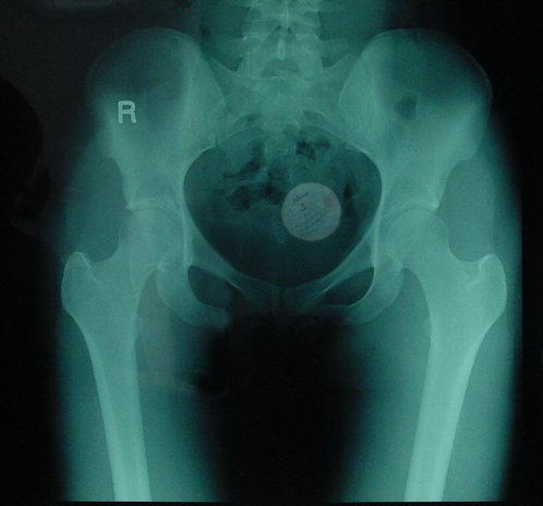 golfballxray.jpg